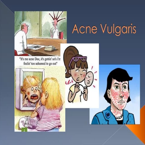 Acne Vulgaris