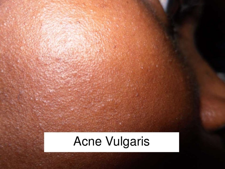 Acne vulgari