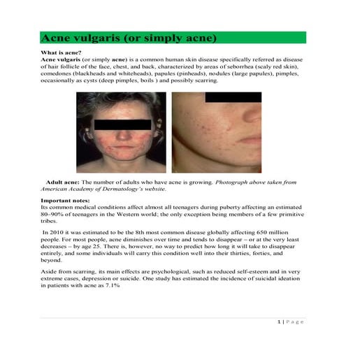Acne vulgaris