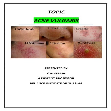 Acne vulgaris