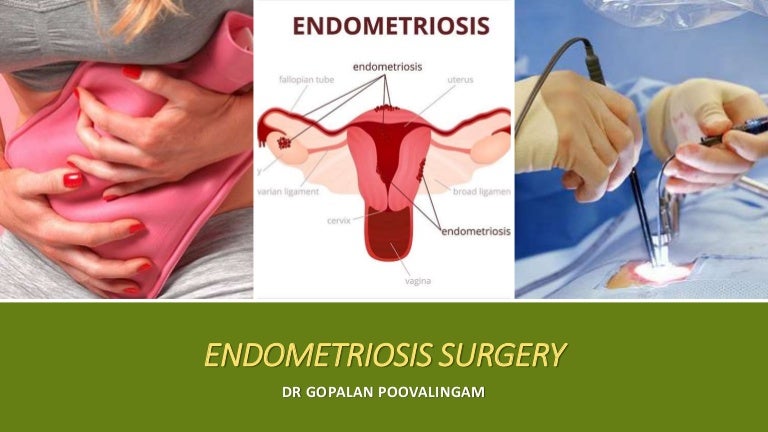 A Complete Overview of Endometriosis Surgery