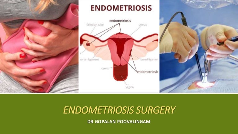 Endometriosis Surgery Endometriosis Facts You Need to