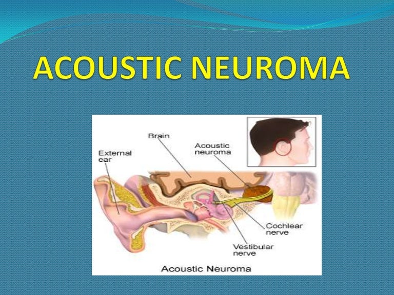 Acoustic neuroma
