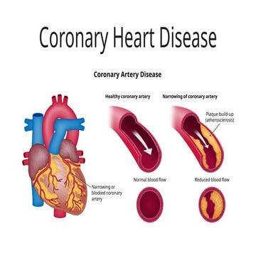 Coronary Heart Disease - Angina Pectoris tx