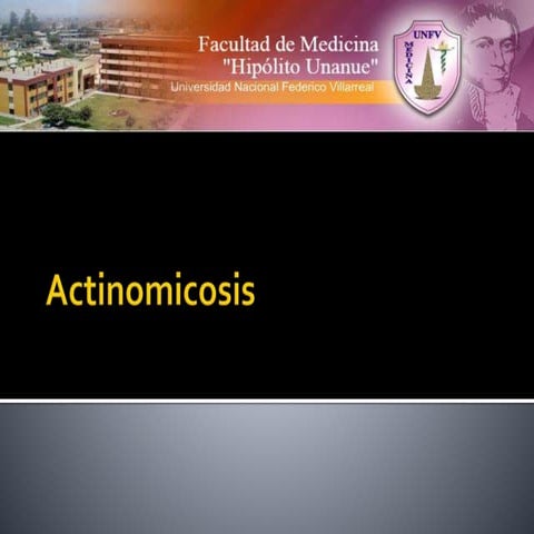 Actinomicosis