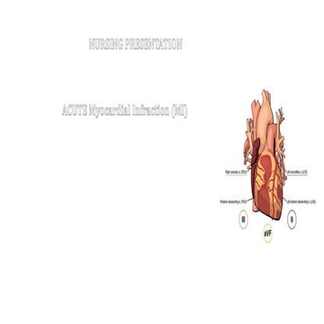 ACUTE antero septal  MI - CASE PRESENTATION RASHED 2.pdf