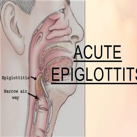 Acute Epiglottits (ppt)