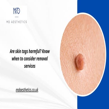Are skin tags harmful? Know when to consider removal services | PPTX