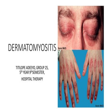 Dermatomyositis PPT