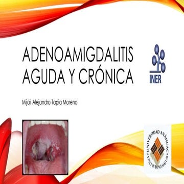 Adenoamigdalitis aguda y crónica