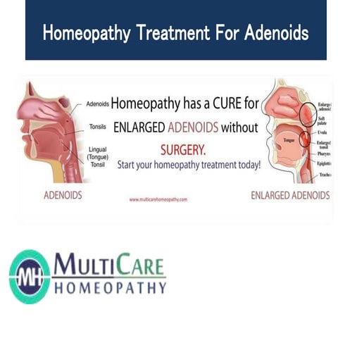 Homeopathic Medicines for ADENOIDS treatment
