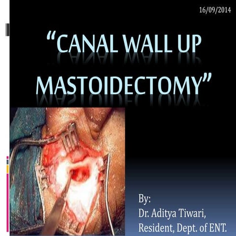 Canal wall up Mastoidectomy ( Intact Bridge Mastoidectomy) by Dr.Aditya Tiwari