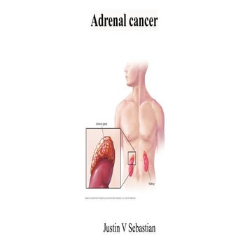 Adrenal cancer