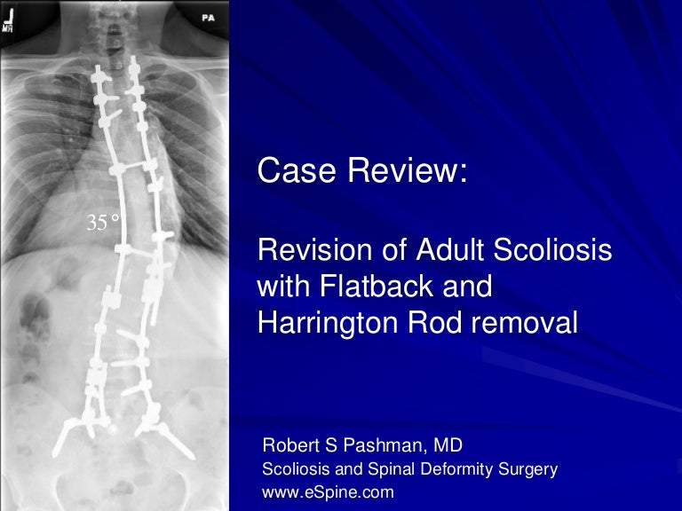 Case Review 1 42 year old make with Adult Scoliosis Harrington Rod