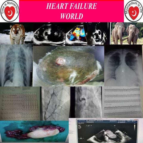 Advanced heart failure september18
