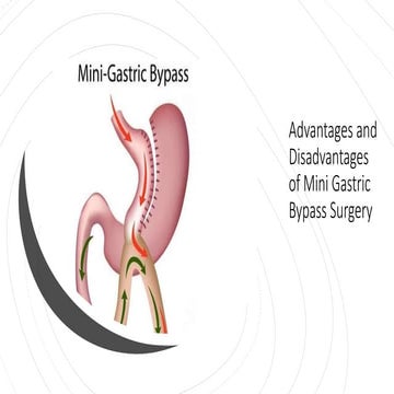 Advantages and Disadvantages of Mini Gastric Bypass Surgery | PPTX