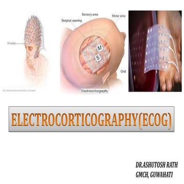 ELECTROCORTICOGRAPHY(ECOG)