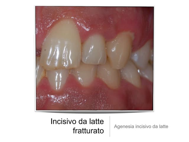 vip más agenesia dental vip más agenesia dental