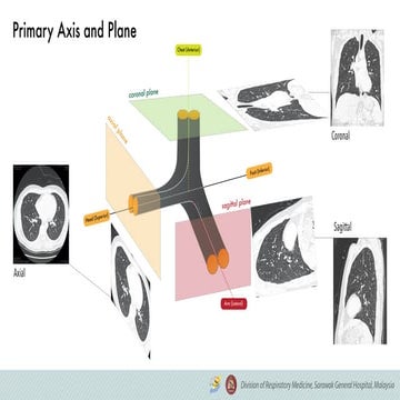 AIRWAY 3D MAPPING - Planes and Axis Bronchial