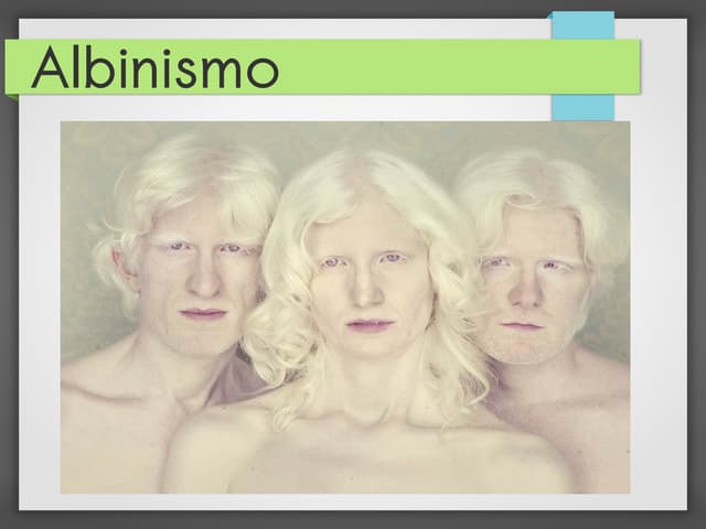 Albinismo