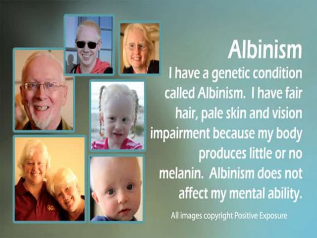 Albinism | PDF