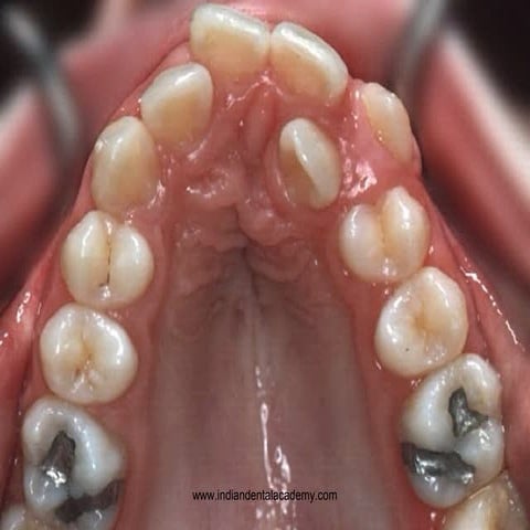 Aligning and leveling in pea2