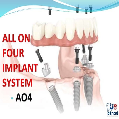 All On Four Dental Implant System