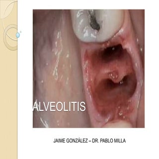 Alveolitis