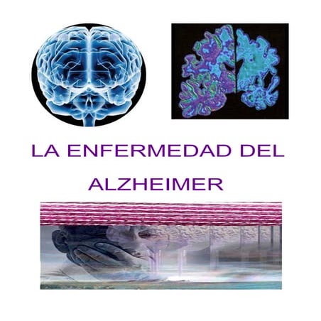 Alzheimer