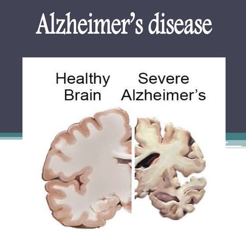Alzheimer's disease : Overview, Symptoms, Risk Factor, Causes, Treatment and ...