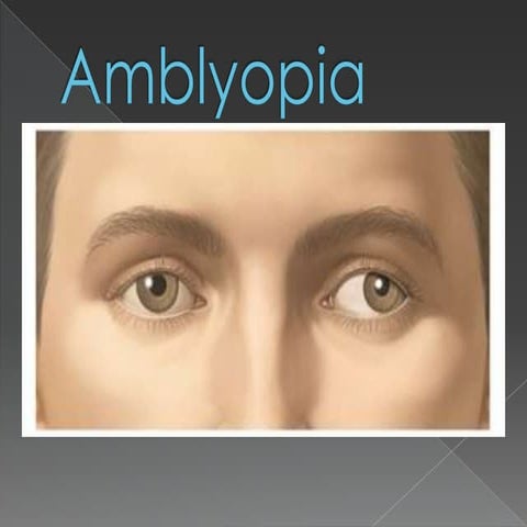 Amblyopia | PPTX
