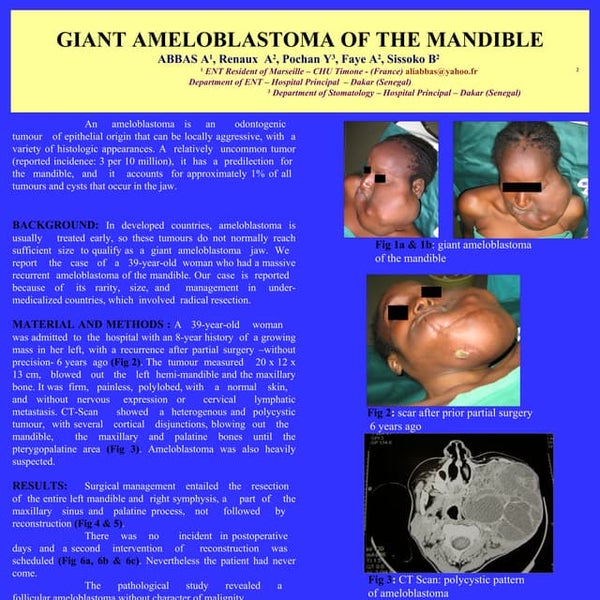 Clinical and radiologic behaviour of ameloblastoma in 4 cases