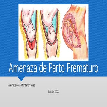 Amenaza de Parto Prematuro - Lucila Montero Yáñez v.1.4.pptx