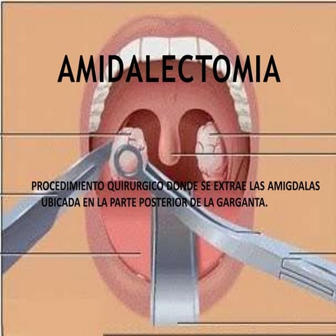 Amigdalectomia 1