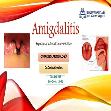 Amigdalitis