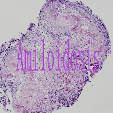 Amiloidosis