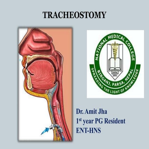 Tracheostomy | PPTX