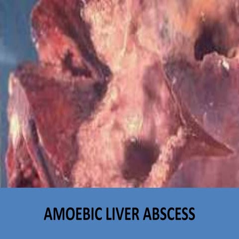 AMOEBIC LIVER ABSCESS