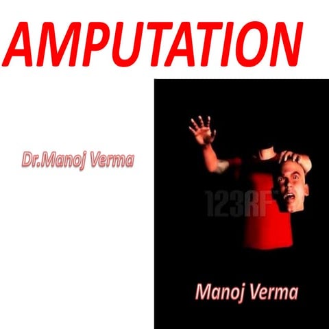Amputation
