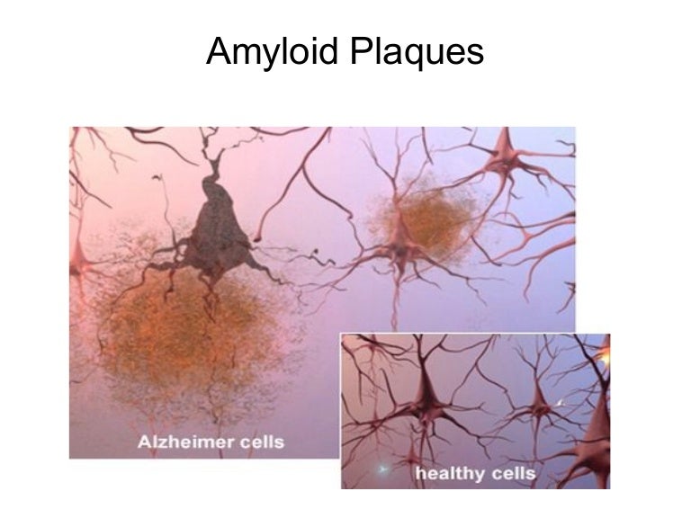 Amyloid plaques