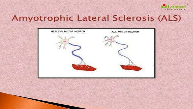 Amyotrophic Lateral Sclerosis Amyotrophic Lateral Sclerosis