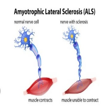 ALS_Detailed_Academic_Presentation .pptx