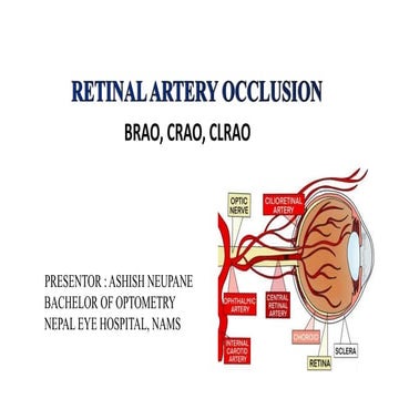 RETINAL ARTERY OCCLUSIONS  CRAO   BRAO   CLRAO