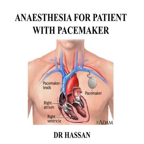 Anaesthesia for patient with pacemaker