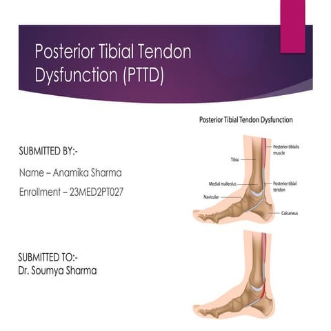 Comprehensive Overview of Posterior Tibial Tendon Dysfunction: Causes ...