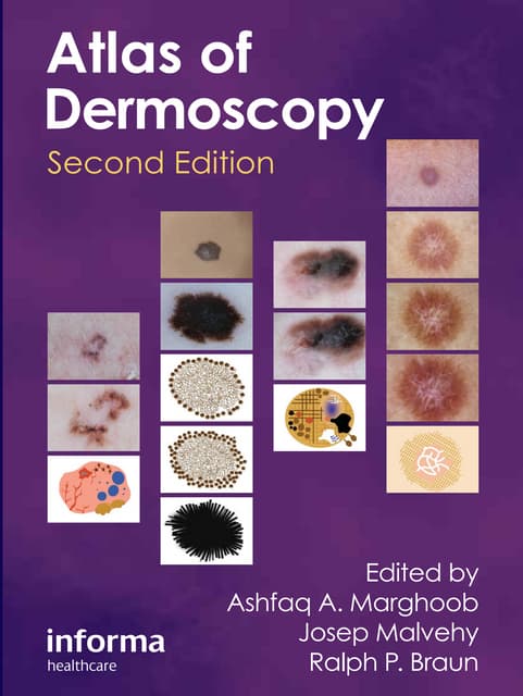 An Atlas of Dermoscopy, Second Edition ( PDFDrive ).pdf