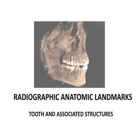 Anatomic landmarks seen in a IOPA