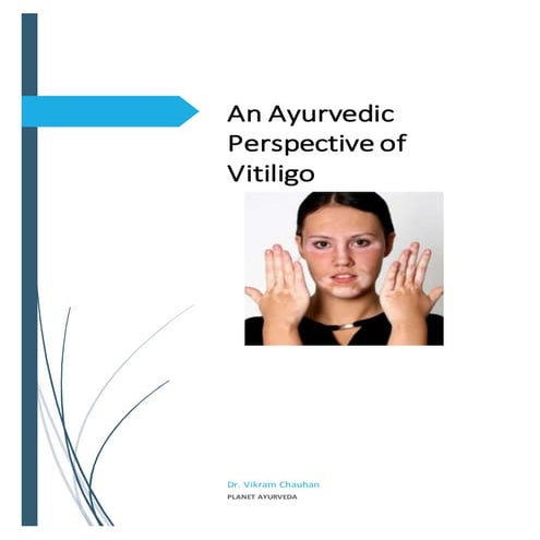 An Ayurvedic Perspective of Vitiligo