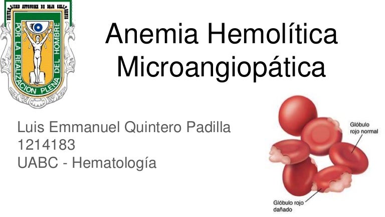 Anemia hemolítica microangiopática