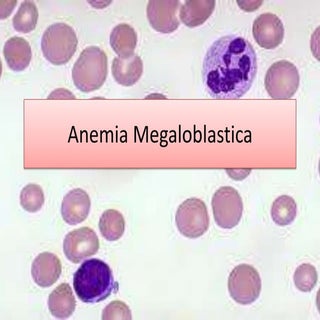 Anemia megaloblastica